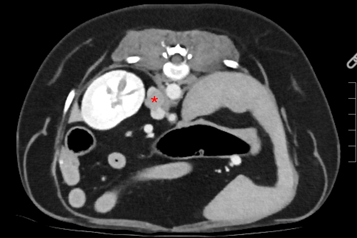 Risk Factors for Rare Adrenal Tumour Revealed by New RVC Study
